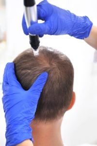 مراقبتهای بعد از میکرونیدلینگ موی سر