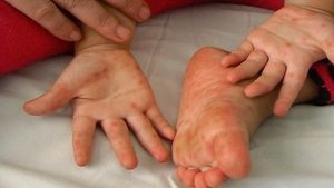 درمان بیماری پوستی اطفال متخصصان پوست و مو کلینیک ایلیا