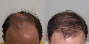 عکس قبل و بعد کربوکسی تراپی مو
