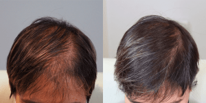 عکس قبل و بعد برای کربوکسی تراپی مو